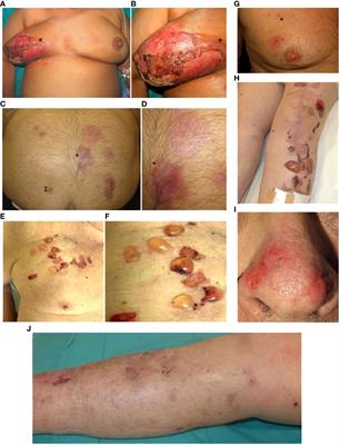 Case Report: Localized bullous pemphigoid induced by local triggers: a case series and a proposal for diagnostic criteria based on a literature review